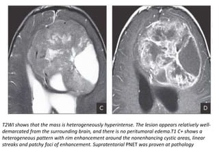 T2WI shows that the mass is heterogeneously hyperintense. The lesion appears relatively well-
demarcated from the surrounding brain, and there is no peritumoral edema.T1 C+ shows a
heterogeneous pattern with rim enhancement around the nonenhancing cystic areas, linear
streaks and patchy foci of enhancement. Supratentorial PNET was proven at pathology
 
