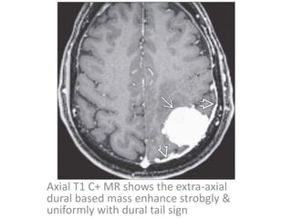 Axial T1 C+ MR shows the extra-axial
dural based mass enhance strobgly &
uniformly with dural tail sign
 