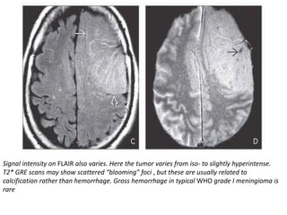 Signal intensity on FLAIR also varies. Here the tumor varies from iso- to slightly hyperintense.
T2* GRE scans may show scattered “blooming” foci , but these are usually related to
calcification rather than hemorrhage. Gross hemorrhage in typical WHO grade I meningioma is
rare
 