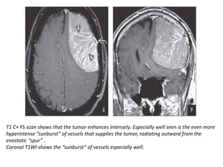 T1 C+ FS scan shows that the tumor enhances intensely. Especially well seen is the even more
hyperintense “sunburst” of vessels that supplies the tumor, radiating outward from the
enostotic “spur” .
Coronal T1WI shows the “sunburst” of vessels especially well.
 