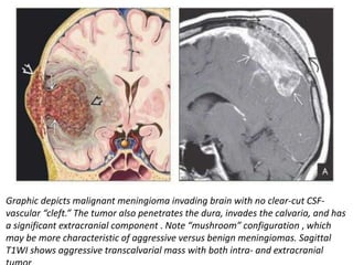 Graphic depicts malignant meningioma invading brain with no clear-cut CSF-
vascular “cleft.” The tumor also penetrates the dura, invades the calvaria, and has
a significant extracranial component . Note “mushroom” configuration , which
may be more characteristic of aggressive versus benign meningiomas. Sagittal
T1WI shows aggressive transcalvarial mass with both intra- and extracranial
 
