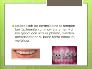  Los brackets de cerámica no se rompen
tan fácilmente, son muy resistentes, y si
son fijados con una luz plasma, pueden
permanecer en su boca tanto como los
metálicos.
 
