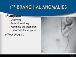 Symptoms:
 Otorrhea
 Parotid swelling
 Mandible pit discharge
 Unilateral facial palsy
Two types :
 