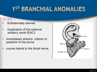 • Ectodermally derived
• Duplication of the external
auditory canal (EAC).
• immediately anterior ,inferior or
posterior to the pinna
• course lateral to the facial nerve,
.
 