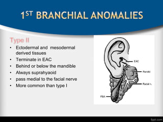 • Ectodermal and mesodermal
derived tissues
• Terminate in EAC
• Behind or below the mandible
• Always suprahyaoid
• pass medial to the facial nerve
• More common than type I
 