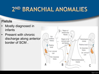 • Mostly diagnosed in
infants
• Present with chronic
discharge along anterior
border of SCM .
 