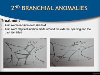 Treatment
• Transverse incision over skin fold
• Transvers elliptical incision made around the external opening and the
tract identified
 