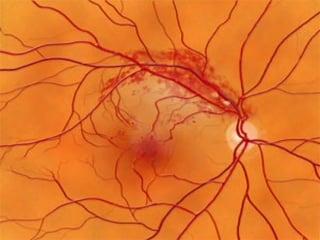 BRANCH RETINAL VEIN OCCLUSION by Fritz Allen MD COPE ID 31524-CL | PPT
