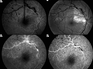 BRANCH RETINAL VEIN OCCLUSION by Fritz Allen MD COPE ID 31524-CL | PPT