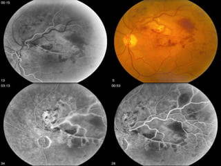 BRANCH RETINAL VEIN OCCLUSION by Fritz Allen MD COPE ID 31524-CL | PPT