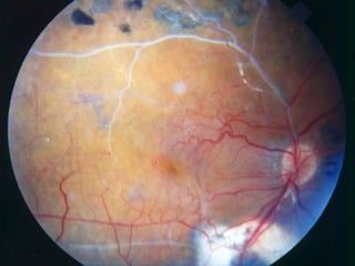 BRANCH RETINAL VEIN OCCLUSION by Fritz Allen MD COPE ID 31524-CL | PPT