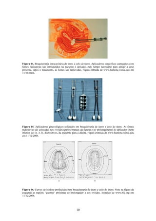10
Figura 04. Braquiterapia intracavitária de útero e colo de útero. Aplicadores específicos carregados com
fontes radioativas são introduzidos na paciente e deixados pelo tempo necessário para atingir a dose
prescrita. Após o tratamento, as fontes são removidas. Figura extraída de www.humonc.winsc.edu em
11/12/2006.
Figura 05. Aplicadores ginecológicos utilizados em braquiterapia de útero e colo do útero. As fontes
radioativas são colocadas nos ovóides (partes brancas da figura) e no prolongamento do aplicador (parte
inferior do 1o. e 3o. dispositivos, da esquerda para a direita. Figura extraída de www.humonc.winsc.edu
em 11/12/2006.
Figura 06. Curvas de isodose produzidas para braquiterapia de útero e colo do útero. Note na figura da
esquerda as regiões "quentes" próximas ao prolongador e aos ovóides. Extraído de www.biij.org em
11/12/2006.
 
