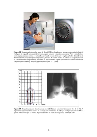 9
Figura 02. Braquiterapia com altas taxas de dose (HDR) realizadas com pós-carregadores (afterloader).
Na figura da esquerda um cateter é introduzido pelo nariz até o pulmão do paciente. Após a introdução o
corpo técnico deixa o recinto e o aplicador robotizado leva as fontes até a região da lesão, deixando-as lá
durante o tempo necessário para atingir a dose prescrita. À direita, detalhe da cabeça do equipamento com
os vários cateteres que podem ser utilizados no procedimento. Figuras extraídas de www.nucletrom.com
(esquerda) e www.valley.radiotherapy.com (direita) em 11/12/2006.
Figura 03. Braquiterapia com altas taxas de dose (HDR) num tumor no lúmen com fios de Ir-192. A
figura da esquerda mostra as curvas de isodose, com um mínimo de radiação nas regiões vizinhas. O fio é
guiado por fluoroscopia (à direita). Figuras extraídas de www.oncologico.org em 11/01/2007.
 