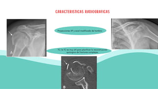 CARACTERISTICAS RADIOGRAFICAS
Proyecciones AP y axial modificada de hombro:
TC: la TC es muy útil para planificar la reconstrucción
quirúrgica de fracturas complejas.
 