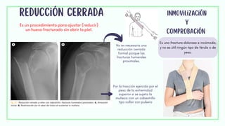 Es una fractura dolorosa e incómoda,
y no es útil ningún tipo de férula o de
yeso.
reducción cerrada
Es un procedimiento para ajustar (reducir)
un hueso fracturado sin abrir la piel.
No es necesaria una
reducción cerrada
formal porque las
fracturas humerales
proximales.
Por la tracción ejercida por el
peso de la extremidad
superior si se sujeta la
muñeca con un cabestrillo
tipo collar con pulsera
Inmovilización
y
comprobación
 