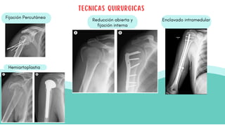 Fijación Percutánea
Reducción abierta y
fijación interna
Enclavado intramedular
TECNICAS QUIRURGICAS
Hemiartoplastia
 
