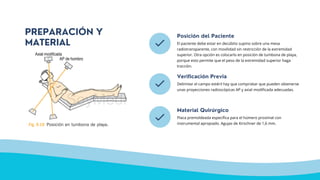 Posición del Paciente
El paciente debe estar en decúbito supino sobre una mesa
radiotransparente, con movilidad sin restricción de la extremidad
superior. Otra opción es colocarlo en posición de tumbona de playa,
porque esto permite que el peso de la extremidad superior haga
tracción.
Verificación Previa
Delimitar el campo estéril hay que comprobar que pueden obtenerse
unas proyecciones radioscópicas AP y axial modificada adecuadas.
Material Quirúrgico
Placa premoldeada específica para el húmero proximal con
instrumental apropiado. Agujas de Kirschner de 1,6 mm.
PREPARACIÓN Y
MATERIAL
 