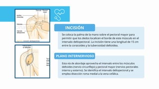INCISIÓN
Se coloca la palma de la mano sobre el pectoral mayor para
permitir que los dedos localicen el borde de este músculo en el
intervalo deltopectoral. La incisión tiene una longitud de 15 cm
entre la coracoides y la tuberosidad deltoidea.
PLANO INTERNERVIOSO
Esta vía de abordaje aprovecha el intervalo entre los músculos
deltoides (nervio circunflejo) y pectoral mayor (nervios pectorales
interno y externo). Se identifica el intervalo deltopectoral y se
emplea disección roma medial a la vena cefálica.
 