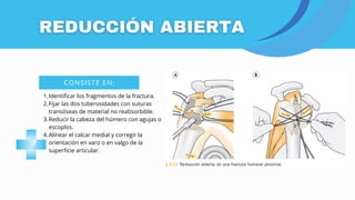 CONSISTE EN:
Identificar los fragmentos de la fractura.
1.
Fijar las dos tuberosidades con suturas
transóseas de material no reabsorbible.
2.
Reducir la cabeza del húmero con agujas o
escoplos.
3.
Alinear el calcar medial y corregir la
orientación en varo o en valgo de la
superficie articular.
4.
 