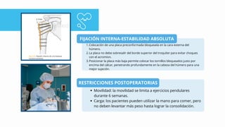 FIJACIÓN INTERNA-ESTABILIDAD ABSOLUTA
RESTRICCIONES POSTOPERATORIAS
Colocación de una placa preconformada bloqueada en la cara externa del
húmero.
1.
La placa no debe sobresalir del borde superior del troquíter para evitar choques
con el acromion.
2.
Posicionar la placa más baja permite colocar los tornillos bloqueados justo por
encima del cálcar, penetrando profundamente en la cabeza del húmero para una
mejor sujeción.
3.
Movilidad: la movilidad se limita a ejercicios pendulares
durante 6 semanas.
Carga: los pacientes pueden utilizar la mano para comer, pero
no deben levantar más peso hasta lograr la consolidación.
 