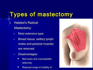 Masterctomy Types Br ca mrm the lect | PPT