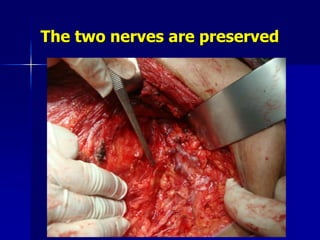 The two nerves are preserved
 