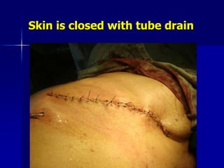 Skin is closed with tube drain
 