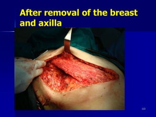 After removal of the breast
and axilla
Friday, October 27, 2023 113
 