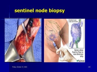 sentinel node biopsy
Friday, October 27, 2023 134
 