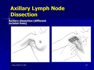 Axillary Lymph Node
Dissection
Axillary dissection (different
incision lines)
Friday, October 27, 2023 137
 