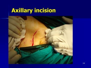 Axillary incision
Friday, October 27, 2023 138
 