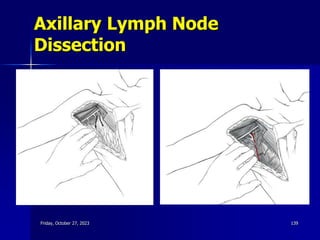 Axillary Lymph Node
Dissection
Friday, October 27, 2023 139
 