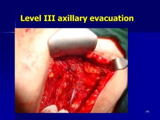 Level III axillary evacuation
Friday, October 27, 2023 140
 