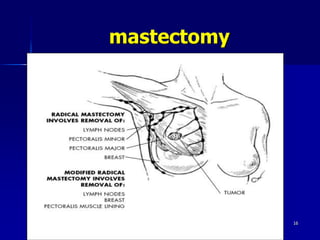 mastectomy
Friday, October 27, 2023 16
 