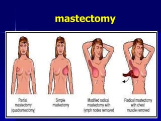 mastectomy
Friday, October 27, 2023 17
 