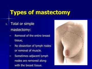 Types of mastectomy
1. Total or simple
mastectomy:
– Removal of the entire breast
tissue,
– No dissection of lymph nodes
or removal of muscle.
– Sometimes adjacent lymph
nodes are removed along
with the breast tissue.
 