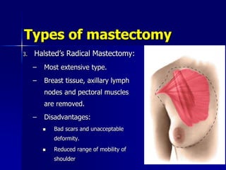 Types of mastectomy
3. Halsted’s Radical Mastectomy:
– Most extensive type.
– Breast tissue, axillary lymph
nodes and pectoral muscles
are removed.
– Disadvantages:
 Bad scars and unacceptable
deformity.
 Reduced range of mobility of
shoulder
 