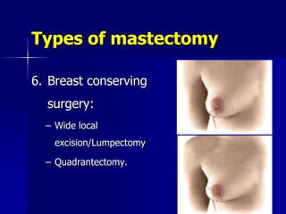 Types of mastectomy
6. Breast conserving
surgery:
– Wide local
excision/Lumpectomy
– Quadrantectomy.
 