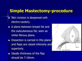 Simple Mastectomy-procedure
 Skin incision is deepened with
electro-cautery.
 A plane between breast fat and
the subcutaneous fat, seen as
white fibrous plane.
 Dissection is carried in this plane
and flaps are raised inferiorly and
superiorly.
 Ideally thickness of the flap
should be 7-10mm.
 