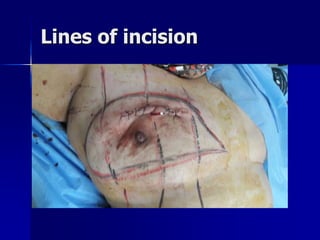 Lines of incision
 