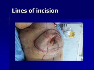 Lines of incision
 