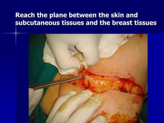 Reach the plane between the skin and
subcutaneous tissues and the breast tissues
 
