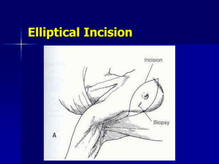Elliptical Incision
 
