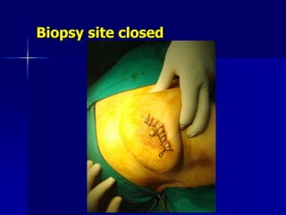 Biopsy site closed
 