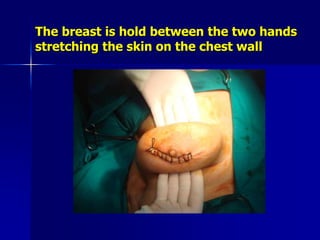 The breast is hold between the two hands
stretching the skin on the chest wall
 