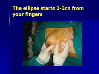 The ellipse starts 2-3cn from
your fingers
 