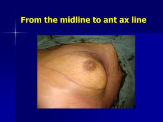 From the midline to ant ax line
 