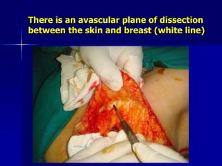 There is an avascular plane of dissection
between the skin and breast (white line)
 