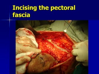 Incising the pectoral
fascia
 