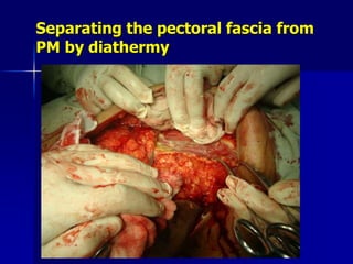 Separating the pectoral fascia from
PM by diathermy
 